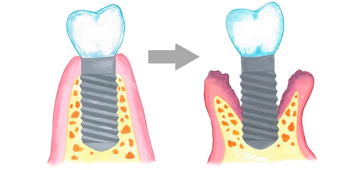 Процесс отторжения имплантата Процесс отторжения имплантата